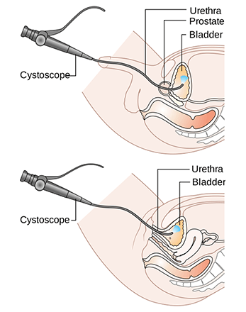 Cystoscopy